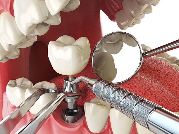 Best Emergency Treatment for Dental Infections or Abscesses in Federal Y, WA